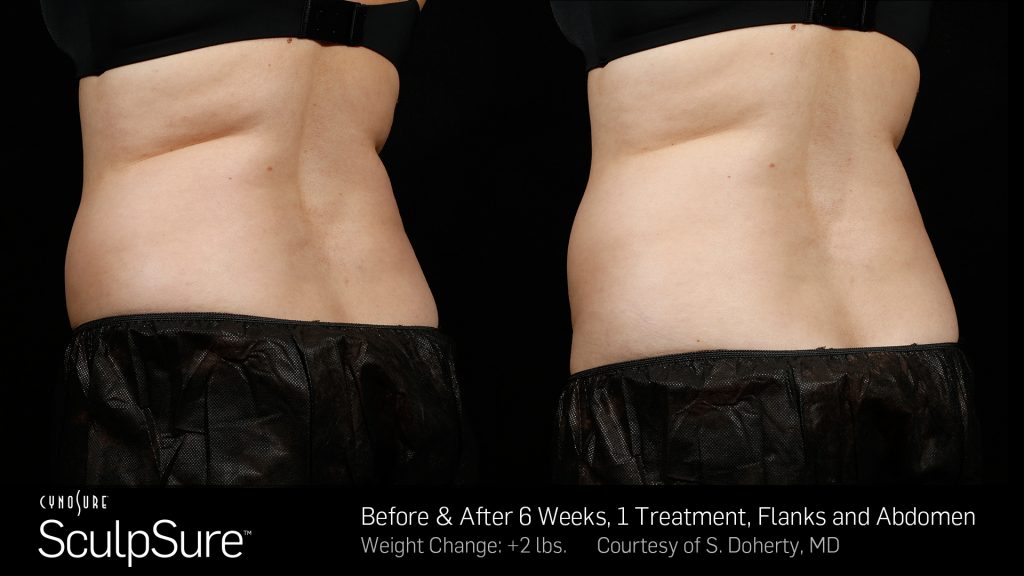 Before and after SculpSure results