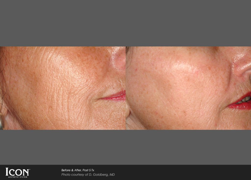 Before and after skin rejuvenation treatments