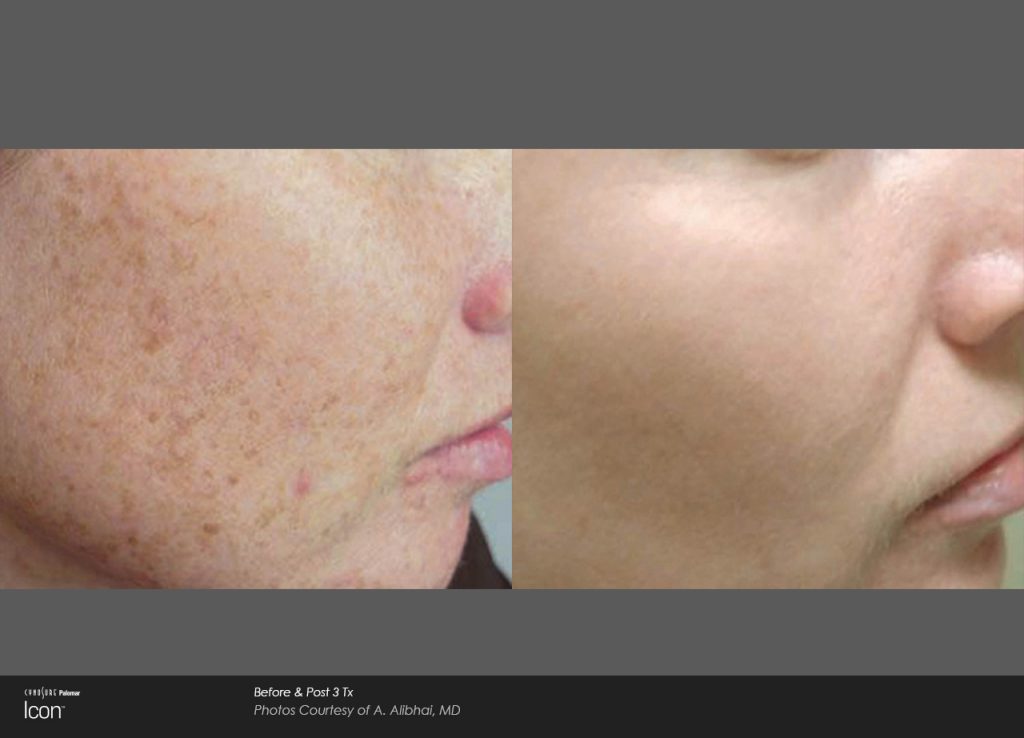 Before and after skin rejuvenation treatments
