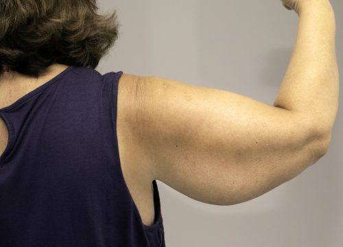 Woman with loose skin on her arms