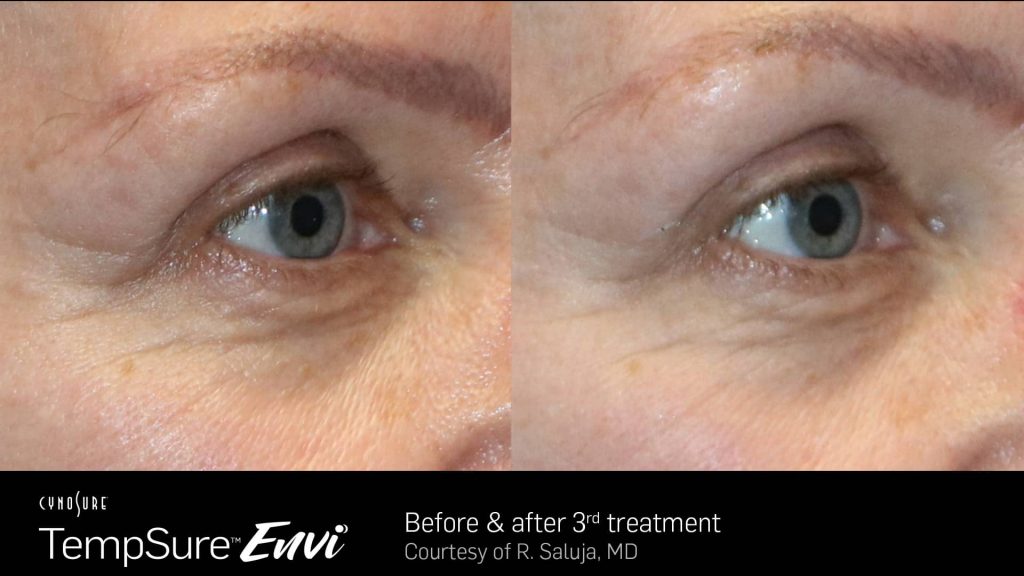 Before and after skin tightening results