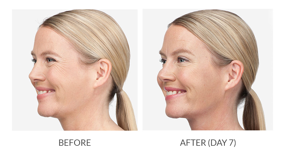 Before and after Botox results