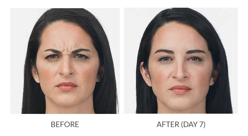 Before and after Botox results