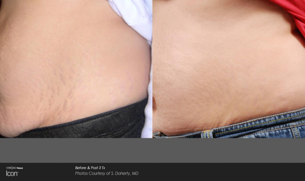 Stretch Mark Reduction  Wyoming Medical Wellness Center +